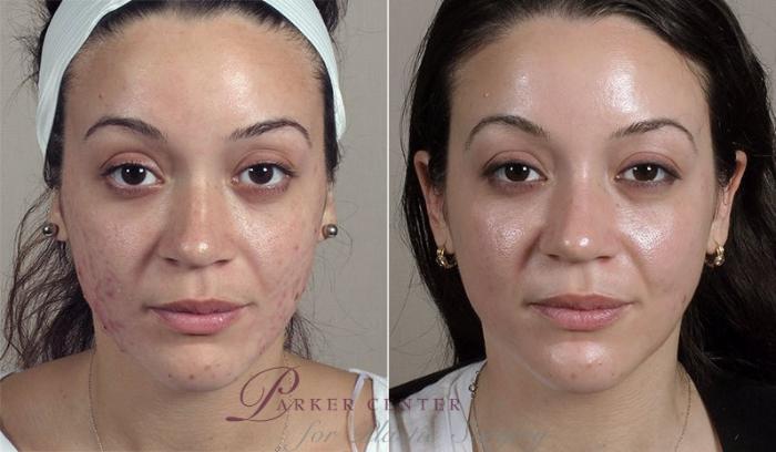 Advanced Acne Treatment Case 327 Before & After View #1 | Paramus, New Jersey | Parker Center for Plastic Surgery