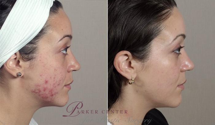 Advanced Acne Treatment Case 327 Before & After View #2 | Paramus, New Jersey | Parker Center for Plastic Surgery