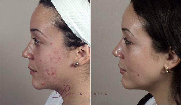 Advanced Acne Treatment Case 327 Before & After View #3 | Paramus, New Jersey | Parker Center for Plastic Surgery