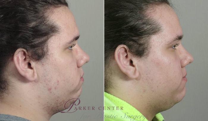 Advanced Acne Treatment Case 328 Before & After View #3 | Paramus, New Jersey | Parker Center for Plastic Surgery