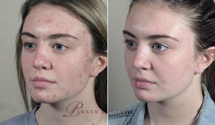 Advanced Acne Treatment Case 330 Before & After View #2 | Paramus, New Jersey | Parker Center for Plastic Surgery