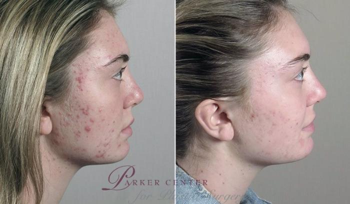 Advanced Acne Treatment Case 330 Before & After View #3 | Paramus, New Jersey | Parker Center for Plastic Surgery