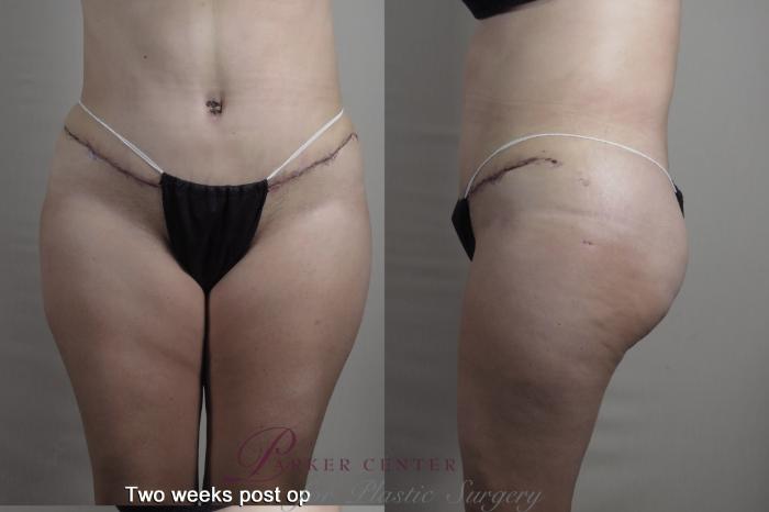 Body Case 1362 Before & After 1 week  | Paramus, NJ | Parker Center for Plastic Surgery