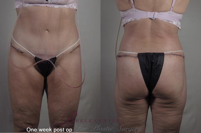 Body Case 1363 Before & After 1 week  | Paramus, NJ | Parker Center for Plastic Surgery