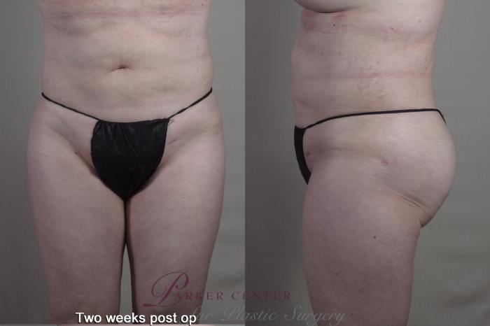 Body Case 1364 Before & After 1 week  | Paramus, NJ | Parker Center for Plastic Surgery