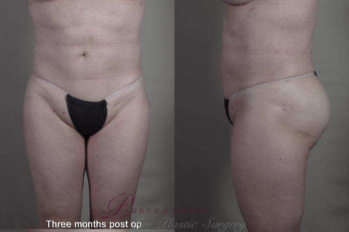 Body Case 1364 Before & After months  | Paramus, NJ | Parker Center for Plastic Surgery