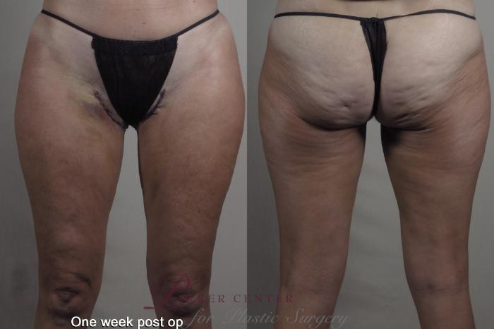 Body Case 1365 Before & After 1 week  | Paramus, NJ | Parker Center for Plastic Surgery