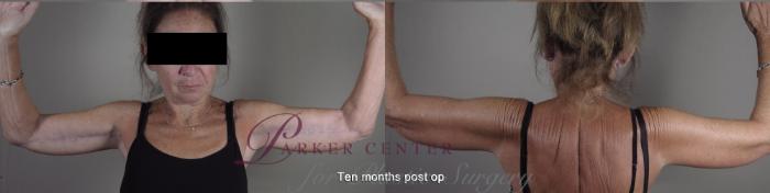 Body Case 1366 Before & After months  | Paramus, NJ | Parker Center for Plastic Surgery