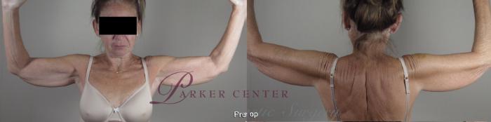 Body Case 1366 Before & After pre op  | Paramus, NJ | Parker Center for Plastic Surgery
