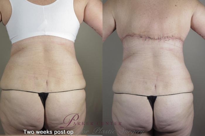 Body Case 1367 Before & After 1 week  | Paramus, NJ | Parker Center for Plastic Surgery