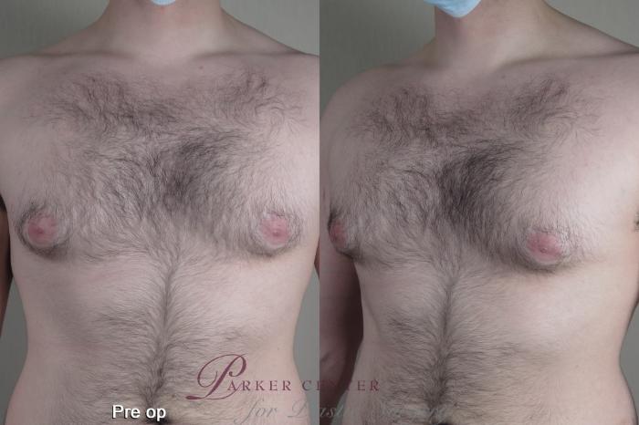 Body Case 1368 Before & After pre op  | Paramus, NJ | Parker Center for Plastic Surgery