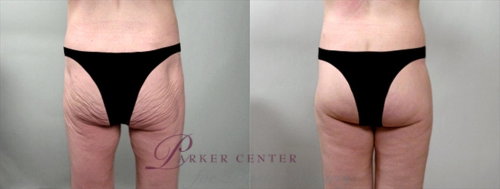 Body Case 853 Before & After View #1 | Paramus, NJ | Parker Center for Plastic Surgery