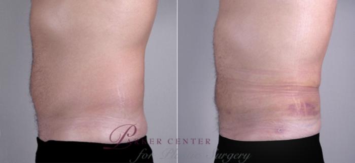 Body Case 854 Before & After View #2 | Paramus, NJ | Parker Center for Plastic Surgery