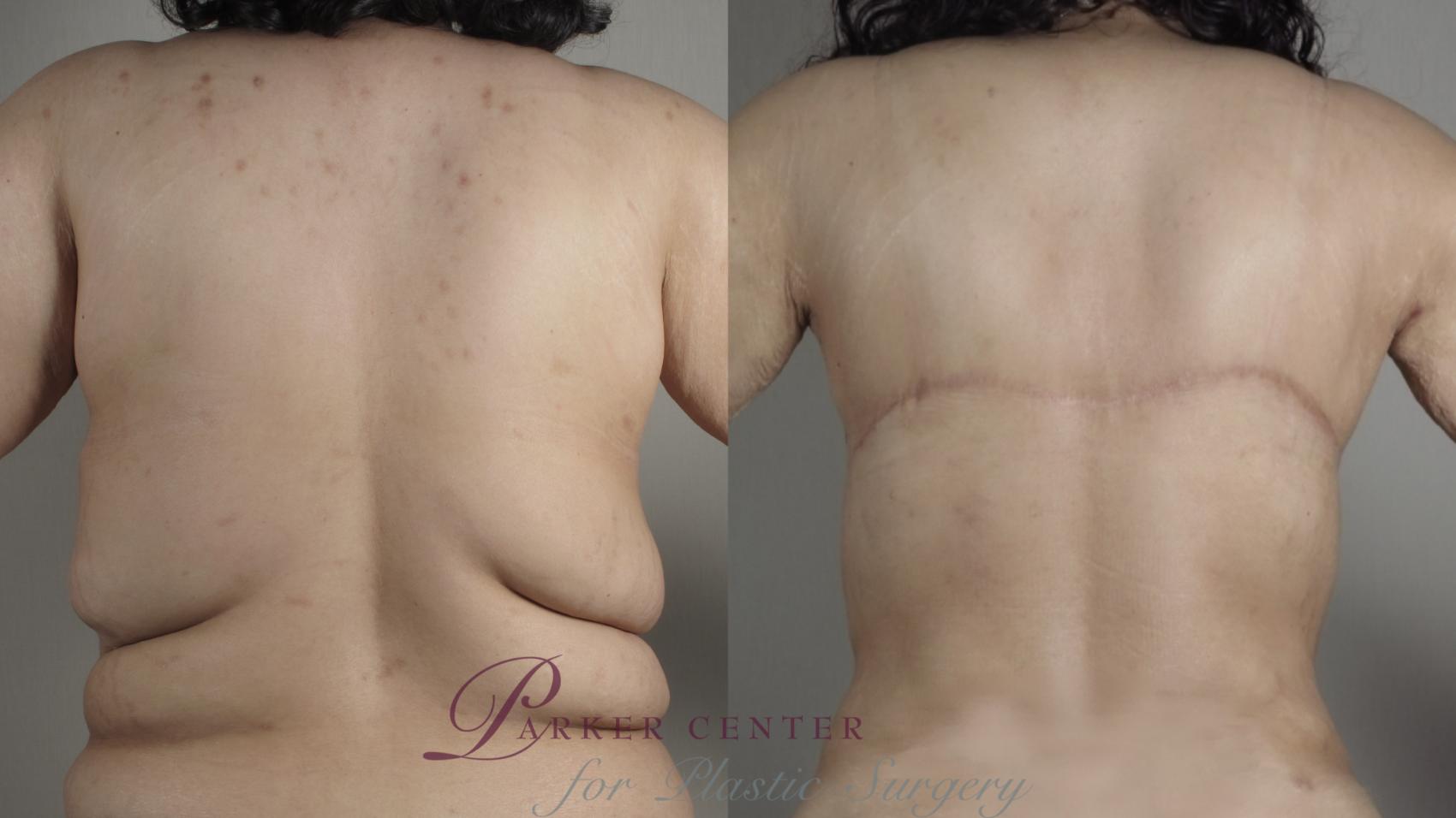 Body Lift Case 1024 Before & After Back | Paramus, NJ | Parker Center for Plastic Surgery