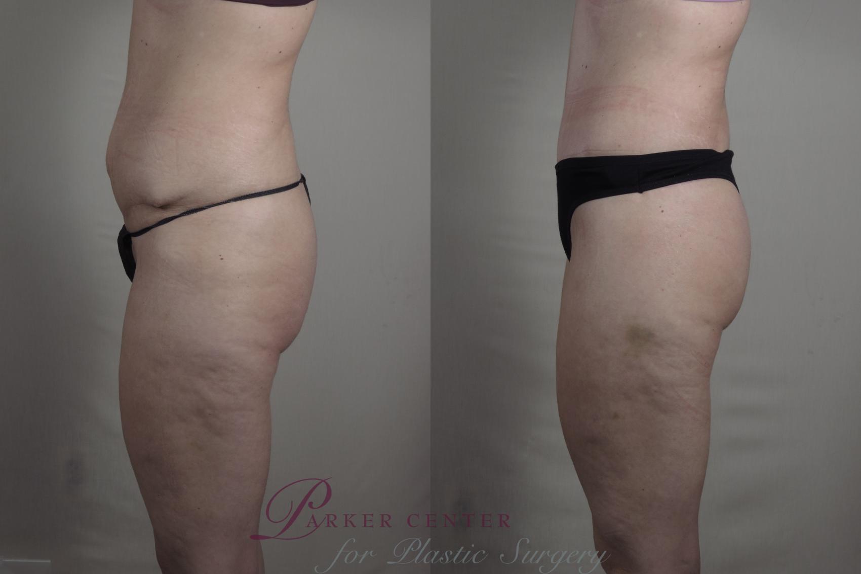 Body Lift Case 1276 Before & After Left Side | Paramus, New Jersey | Parker Center for Plastic Surgery