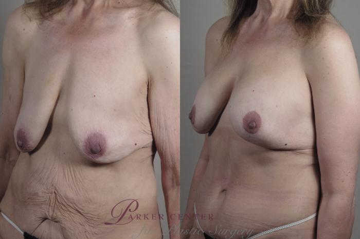 Body Lift Case 1302 Before & After Left Oblique | Paramus, NJ | Parker Center for Plastic Surgery