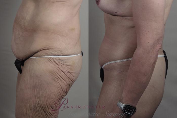 Body Lift Case 1302 Before & After Left Side | Paramus, NJ | Parker Center for Plastic Surgery