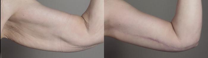 Body Lift Case 1302 Before & After right arm | Paramus, New Jersey | Parker Center for Plastic Surgery