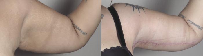 Body Lift Case 1321 Before & After arm 2 | Paramus, New Jersey | Parker Center for Plastic Surgery