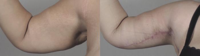 Body Lift Case 1321 Before & After arms | Paramus, New Jersey | Parker Center for Plastic Surgery