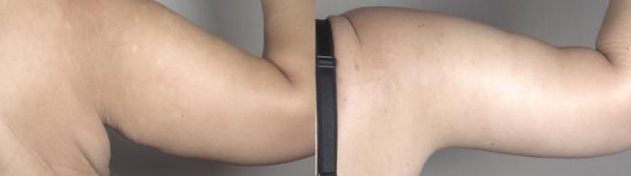 Body Lift Case 1321 Before & After back 2 | Paramus, New Jersey | Parker Center for Plastic Surgery