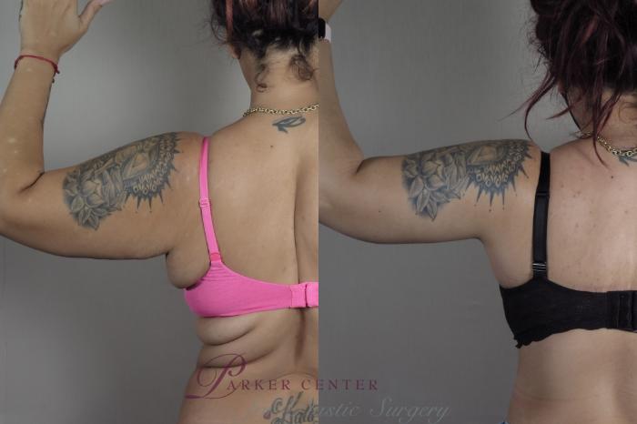Tummy Tuck Case 1321 Before & After back arm view  | Paramus, NJ | Parker Center for Plastic Surgery