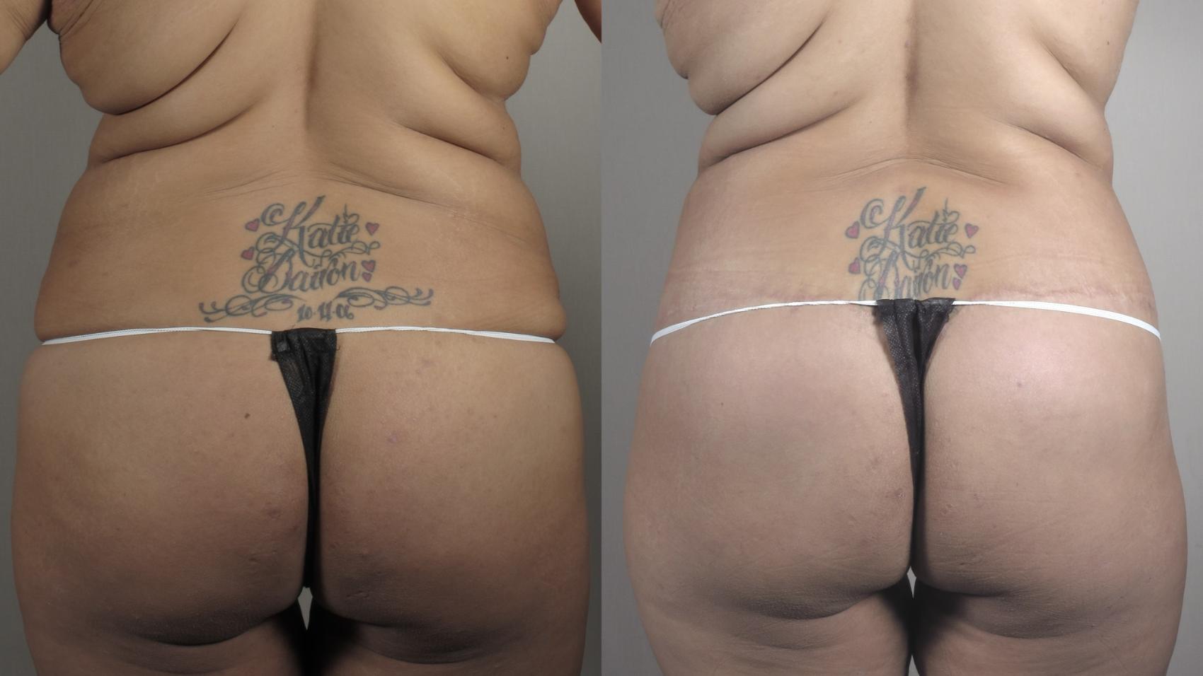 Body Lift Case 1321 Before & After back | Paramus, New Jersey | Parker Center for Plastic Surgery