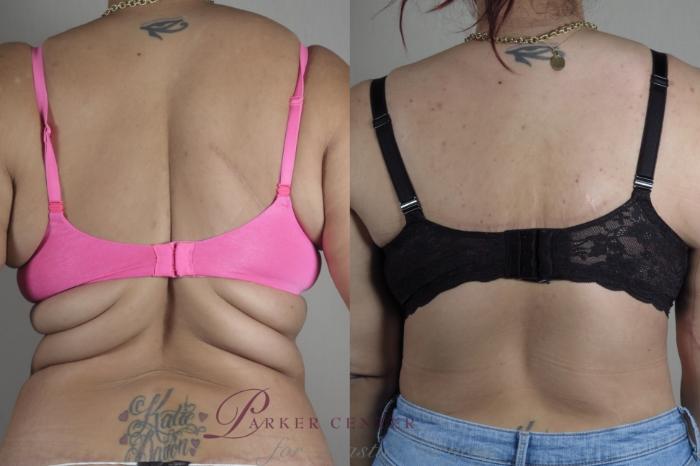 Liposuction Case 1321 Before & After Back | Paramus, NJ | Parker Center for Plastic Surgery