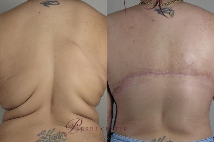 Liposuction Case 1321 Before & After back view 2 braless  | Paramus, NJ | Parker Center for Plastic Surgery