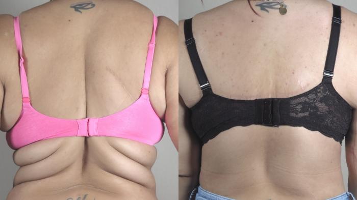 Body Lift Case 1321 Before & After back2 | Paramus, New Jersey | Parker Center for Plastic Surgery