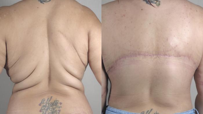 Body Lift Case 1321 Before & After back3 | Paramus, New Jersey | Parker Center for Plastic Surgery