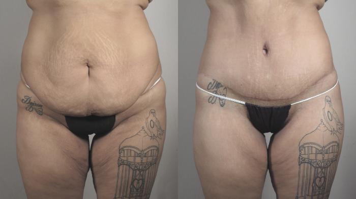 Body Lift Case 1321 Before & After front 2 | Paramus, New Jersey | Parker Center for Plastic Surgery