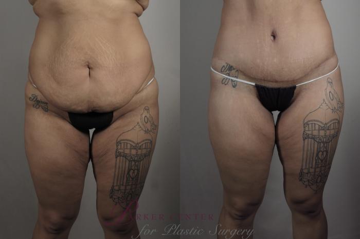 Liposuction Case 1321 Before & After Front | Paramus, NJ | Parker Center for Plastic Surgery