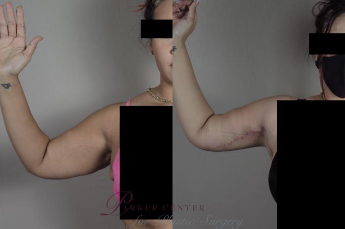 Liposuction Case 1321 Before & After front view arm  | Paramus, NJ | Parker Center for Plastic Surgery