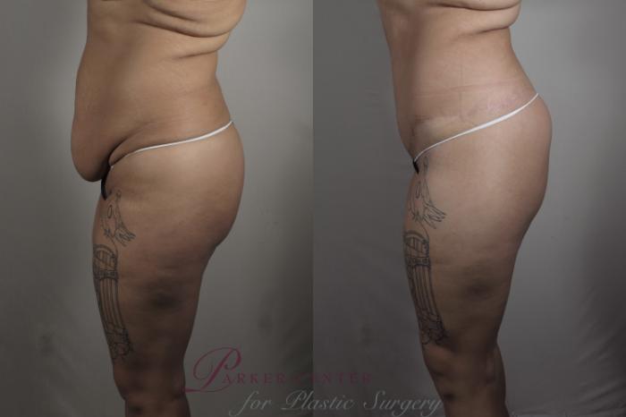 Liposuction Case 1321 Before & After Left Side | Paramus, NJ | Parker Center for Plastic Surgery
