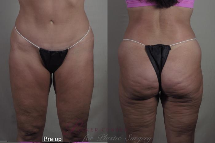 Body Lift Case 1363 Before & After pre op  | Paramus, New Jersey | Parker Center for Plastic Surgery