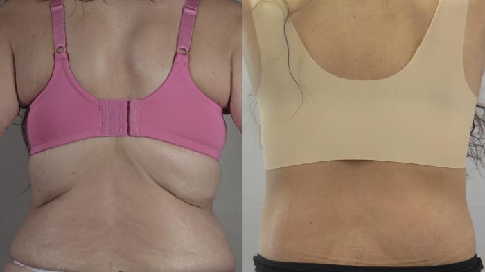 Body Lift Case 1585 Before & After back 1 | Paramus, New Jersey | Parker Center for Plastic Surgery