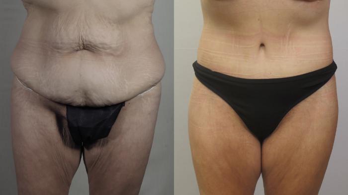 Body Lift Case 1585 Before & After Front | Paramus, New Jersey | Parker Center for Plastic Surgery