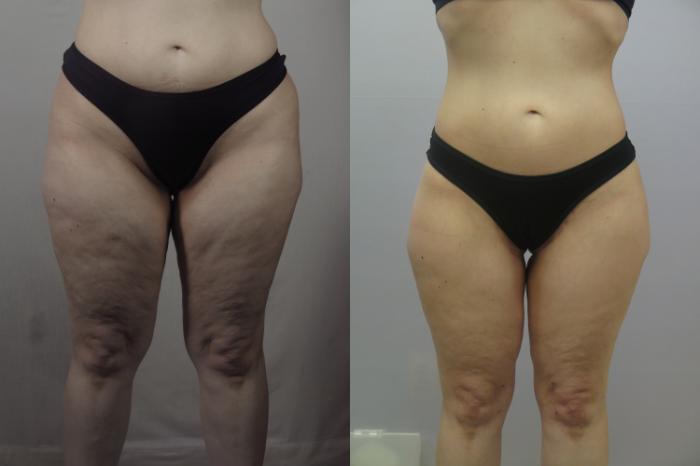 Body Lift Case 1606 Before & After Front | Paramus, New Jersey | Parker Center for Plastic Surgery
