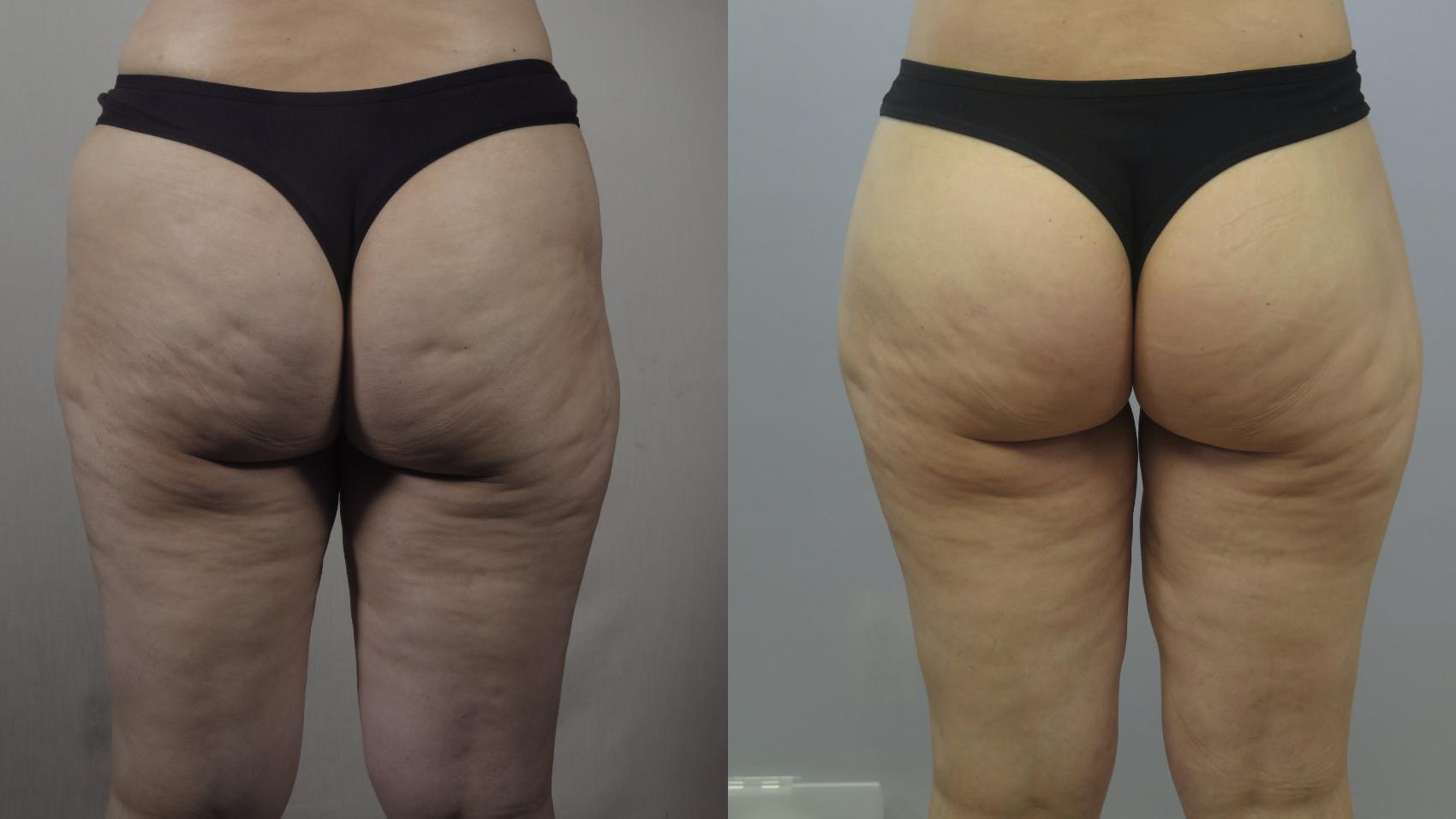Body Lift Case 1606 Before & After Left Side | Paramus, New Jersey | Parker Center for Plastic Surgery