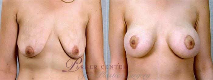 Breast Asymmetry Case 448 Before & After View #1 | Paramus, NJ | Parker Center for Plastic Surgery