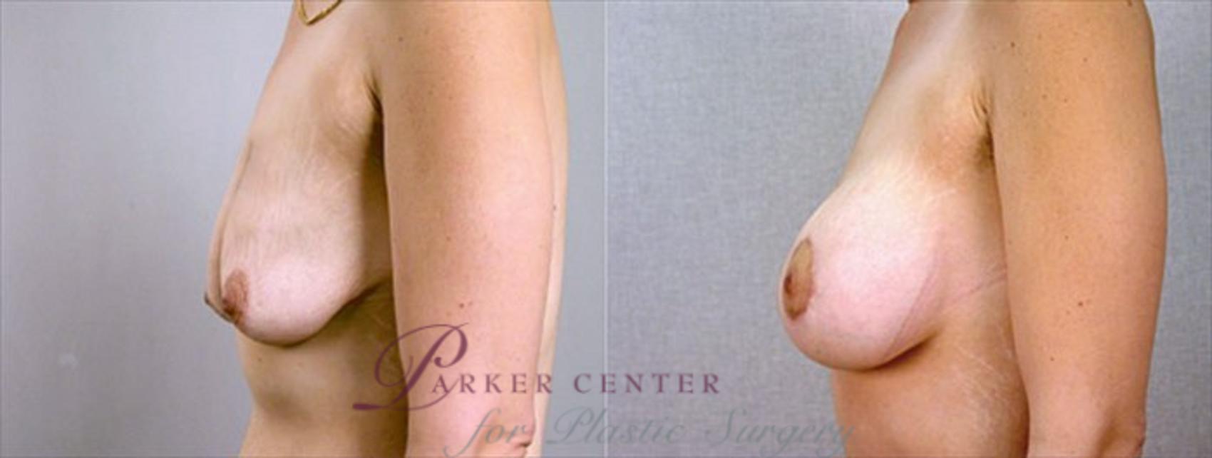 Breast Asymmetry Case 448 Before & After View #2 | Paramus, NJ | Parker Center for Plastic Surgery