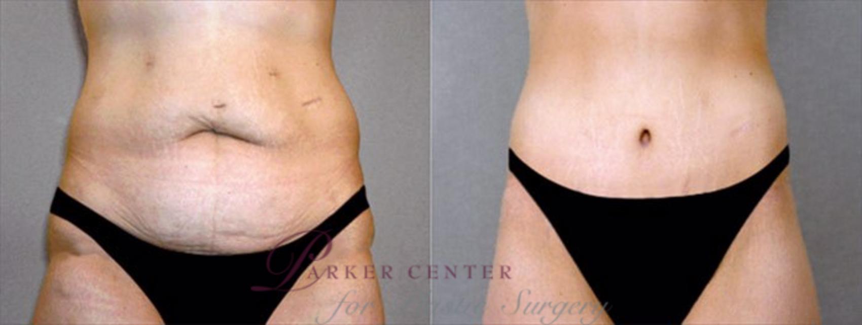 Breast Asymmetry Case 448 Before & After View #3 | Paramus, NJ | Parker Center for Plastic Surgery