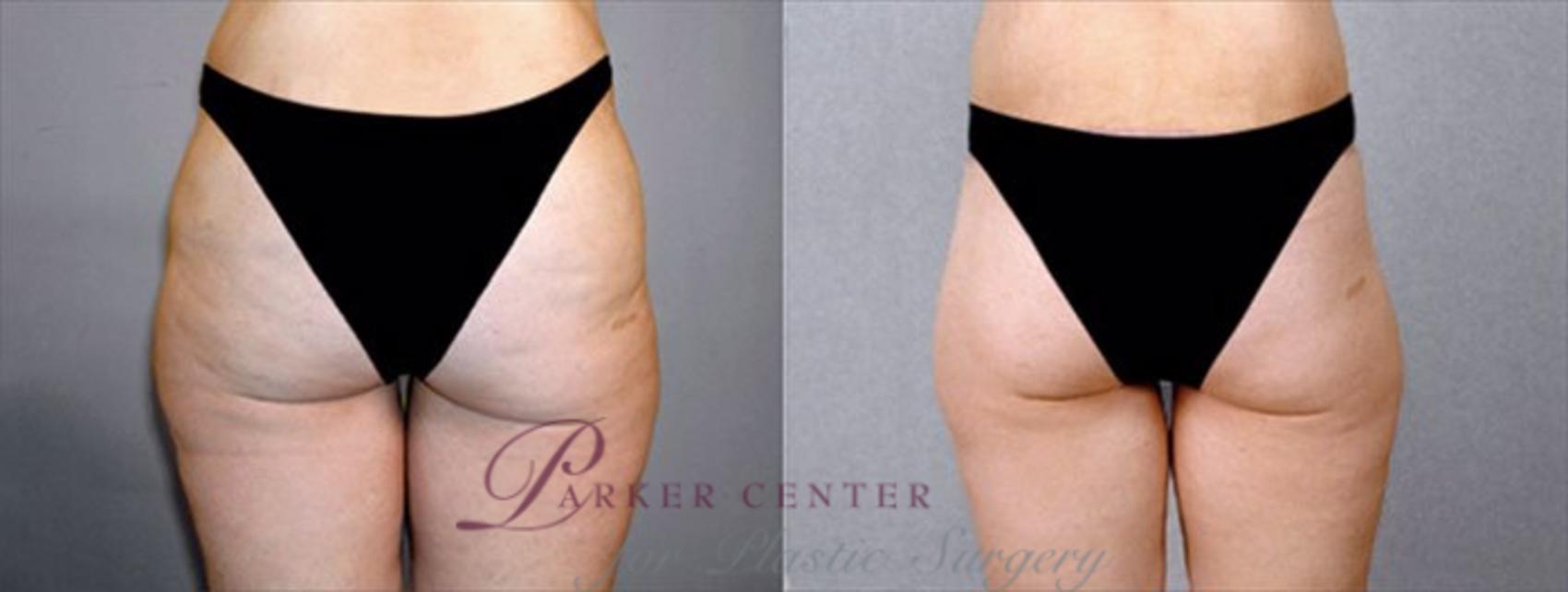 Breast Asymmetry Case 448 Before & After View #4 | Paramus, NJ | Parker Center for Plastic Surgery