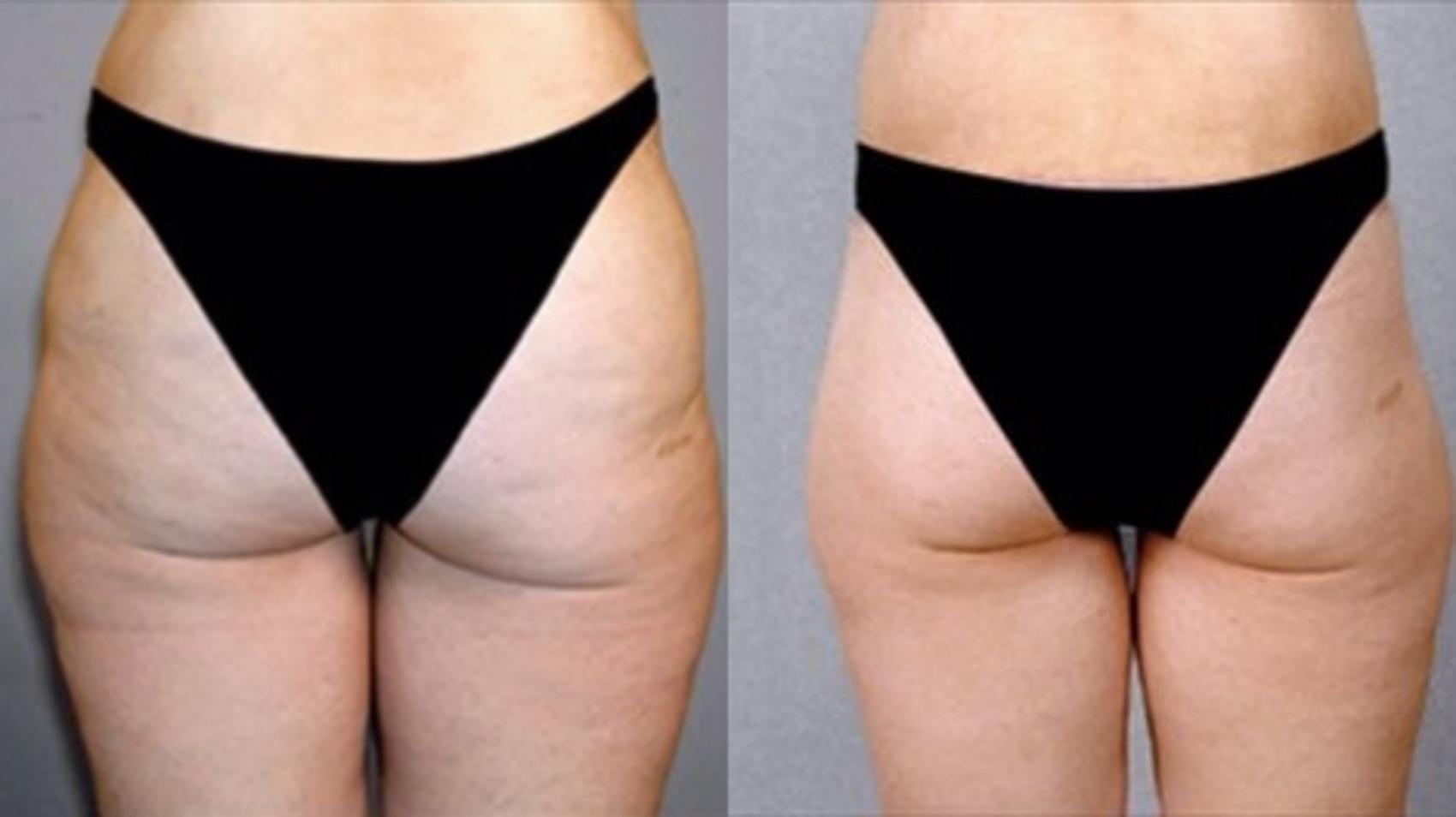 Body Lift Case 448 Before & After View #4 | Paramus, NJ | Parker Center for Plastic Surgery