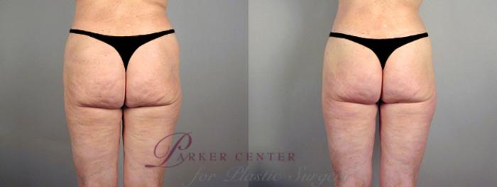 Thigh Lift Case 714 Before & After View #2 | Paramus, NJ | Parker Center for Plastic Surgery