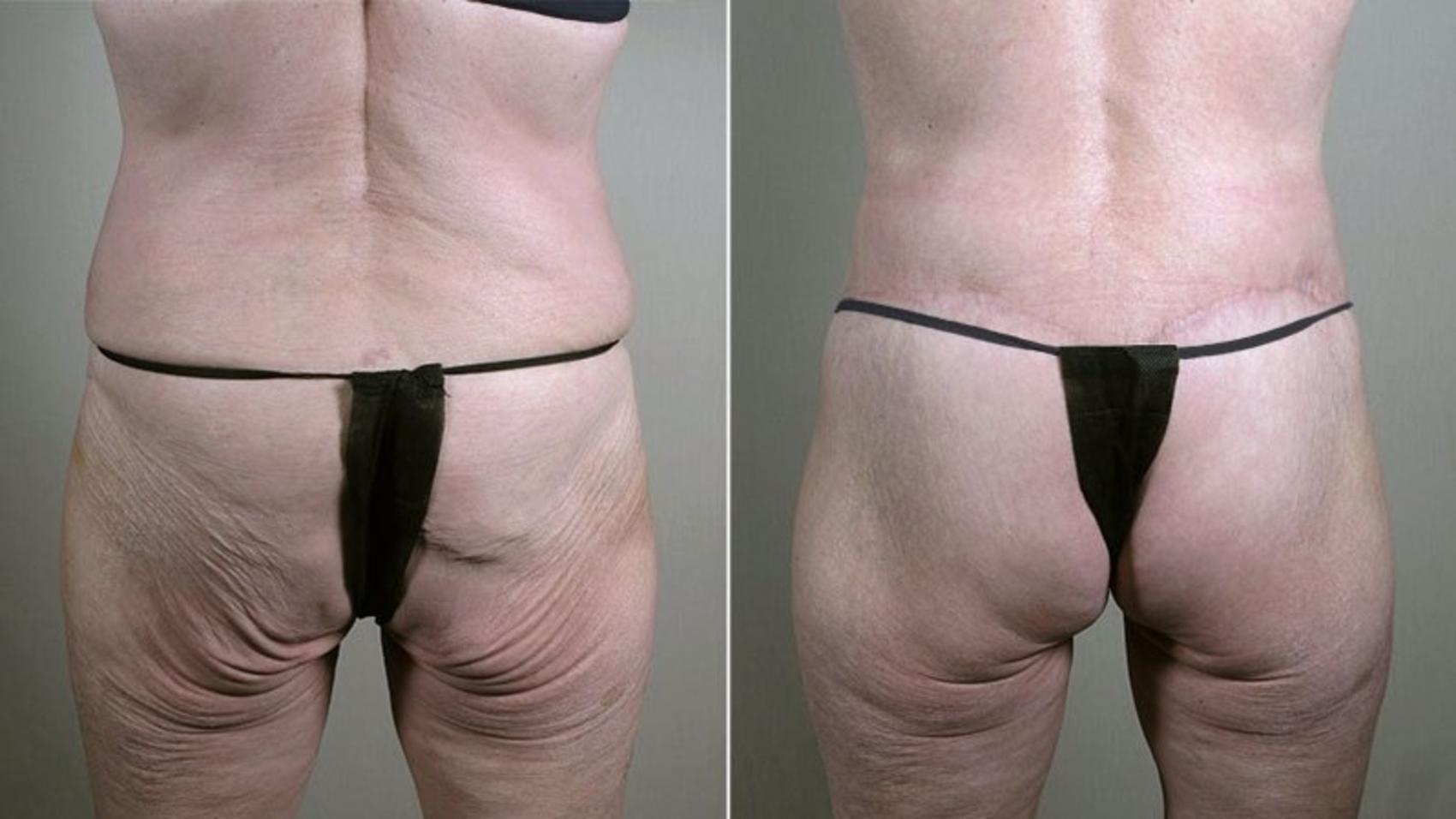 Body Lift Case 754 Before & After View #3 | Paramus, NJ | Parker Center for Plastic Surgery