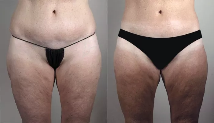 Body Lift Before and After Pictures Case 819, Paramus, NJ