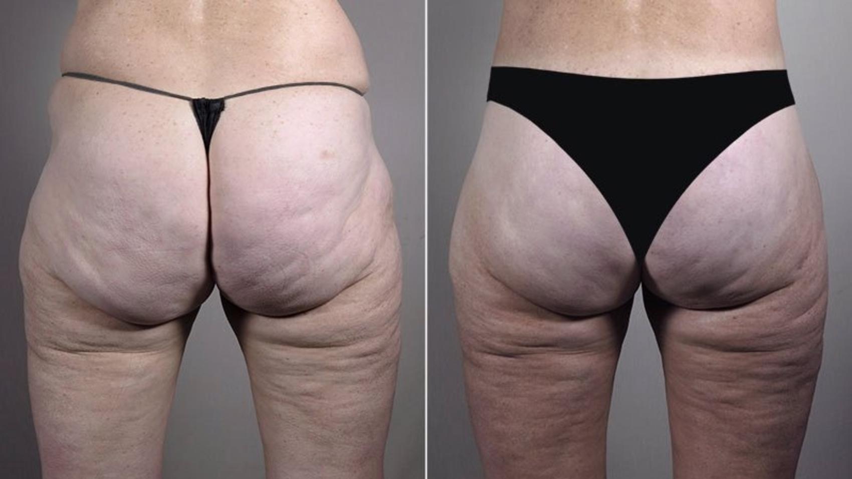 Body Lift Before and After Pictures Case 819, Paramus, NJ