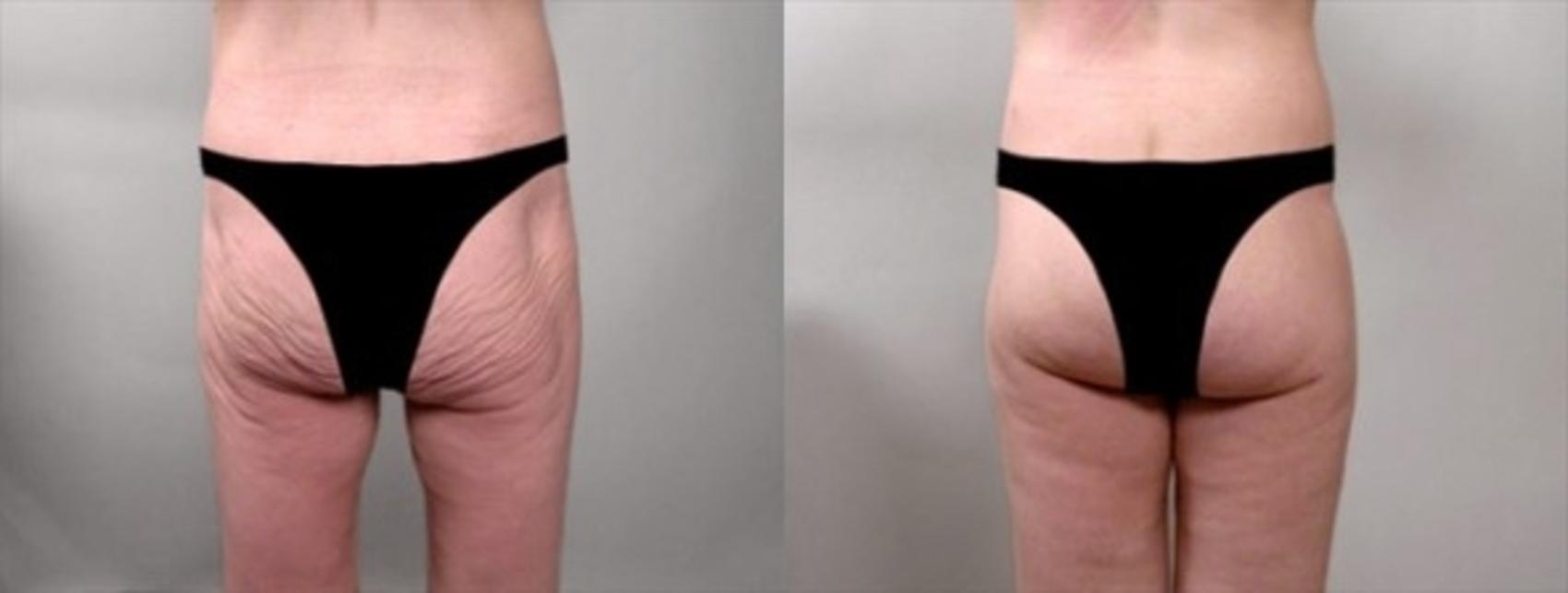 Body Lift Case 920 Before & After View #1 | Paramus, NJ | Parker Center for Plastic Surgery